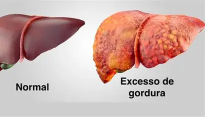 Fígado gorduroso: quando a condição deixa de ser silenciosa e passa a oferecer risco